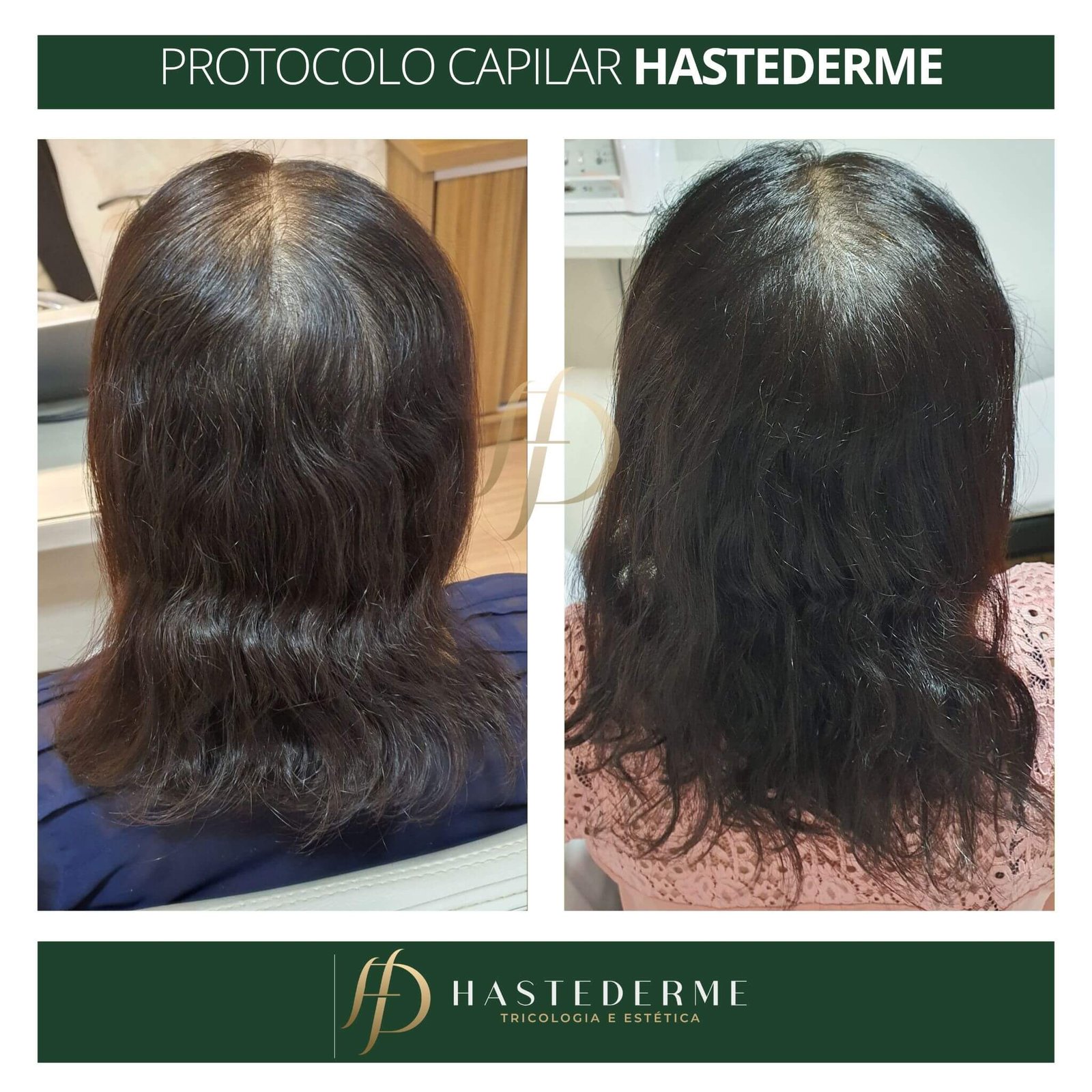 ANTES E DEPOIS HASTEDERME