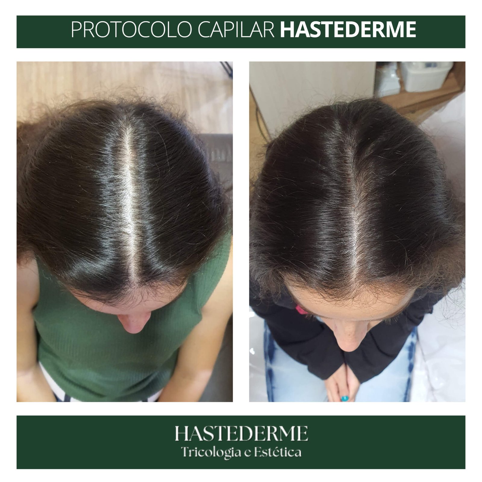 HASTEDERME TRATAMENTO CAPILAR