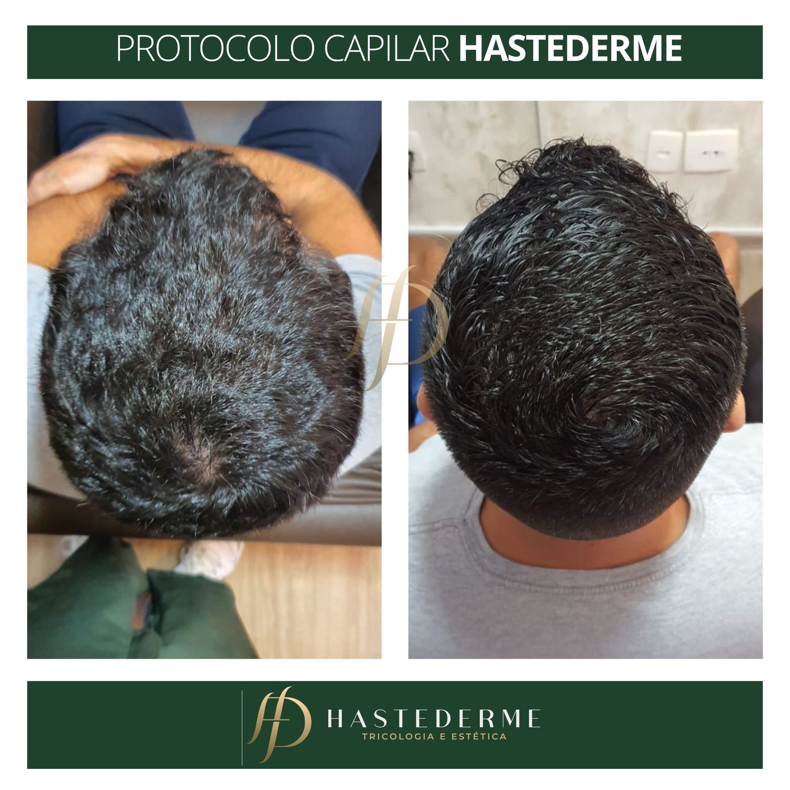 tratamento de recuperação capilar da hastederme
