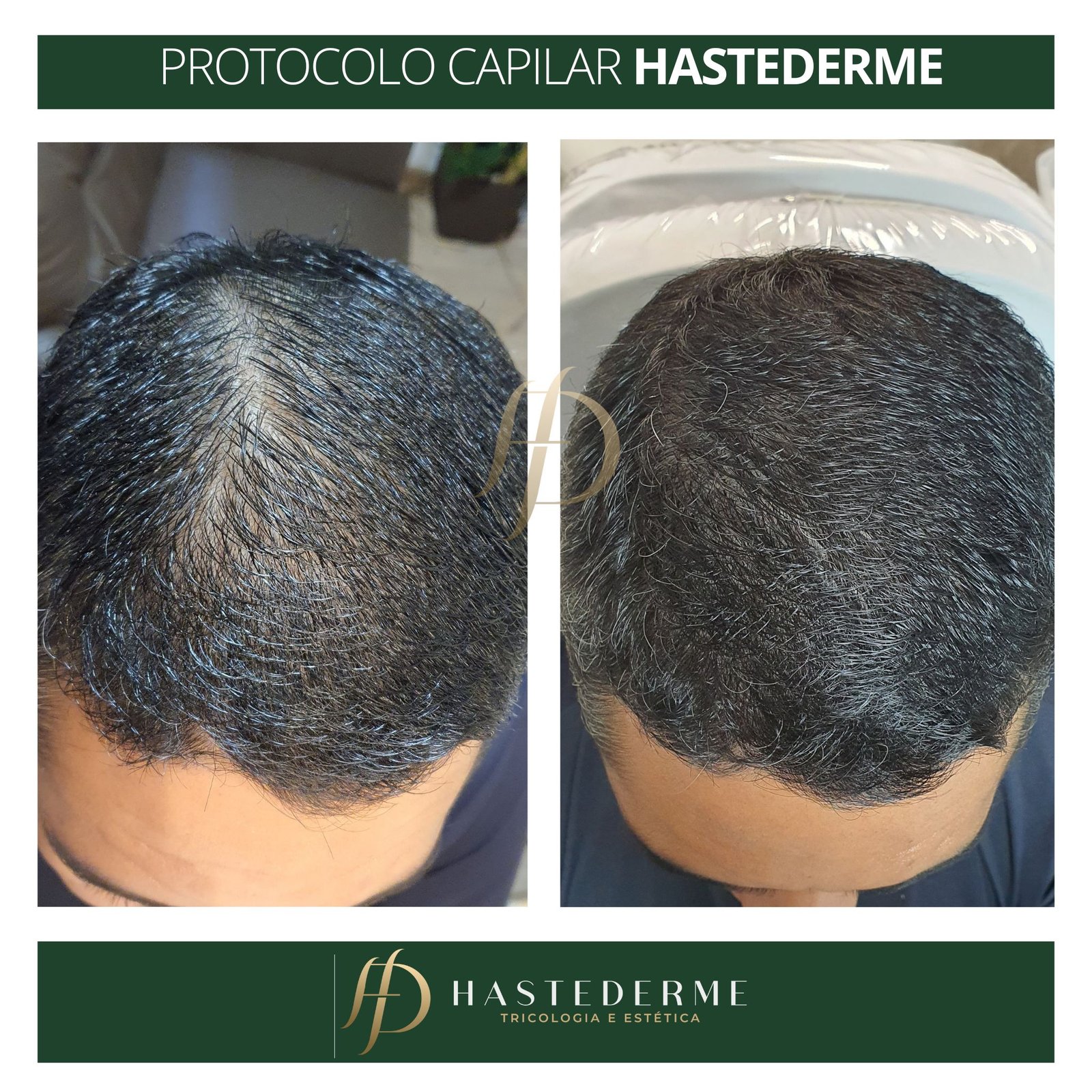 tratamento calvicie