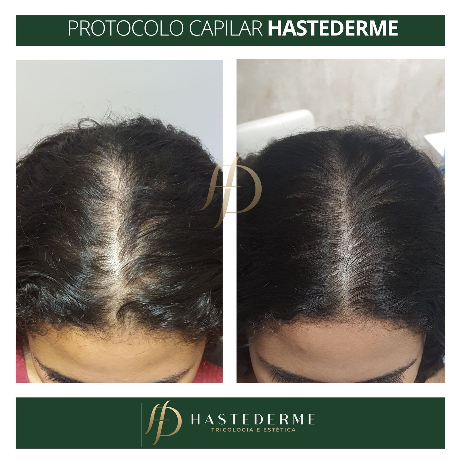 tratamento calvicie feminina