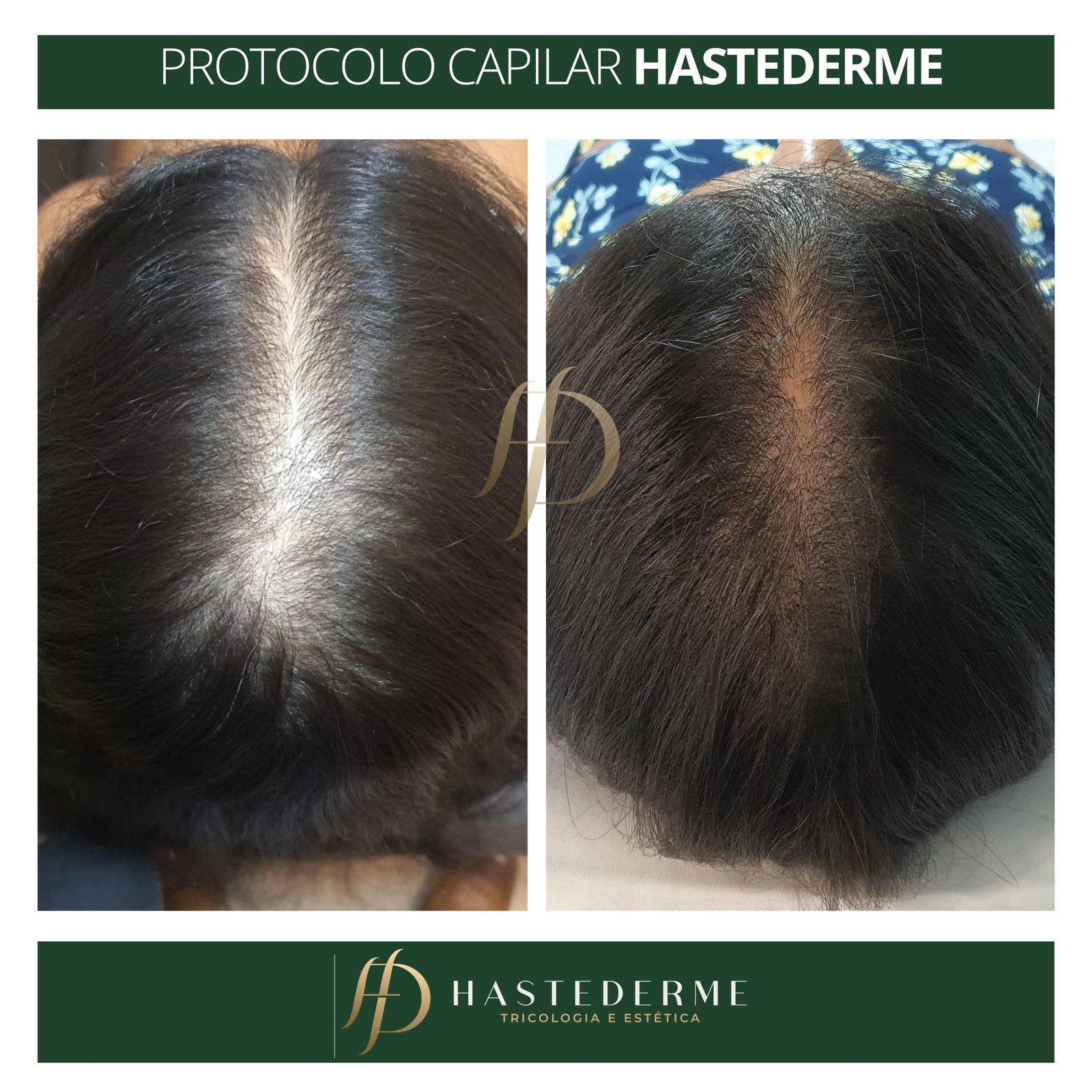tratamento calvicie feminina