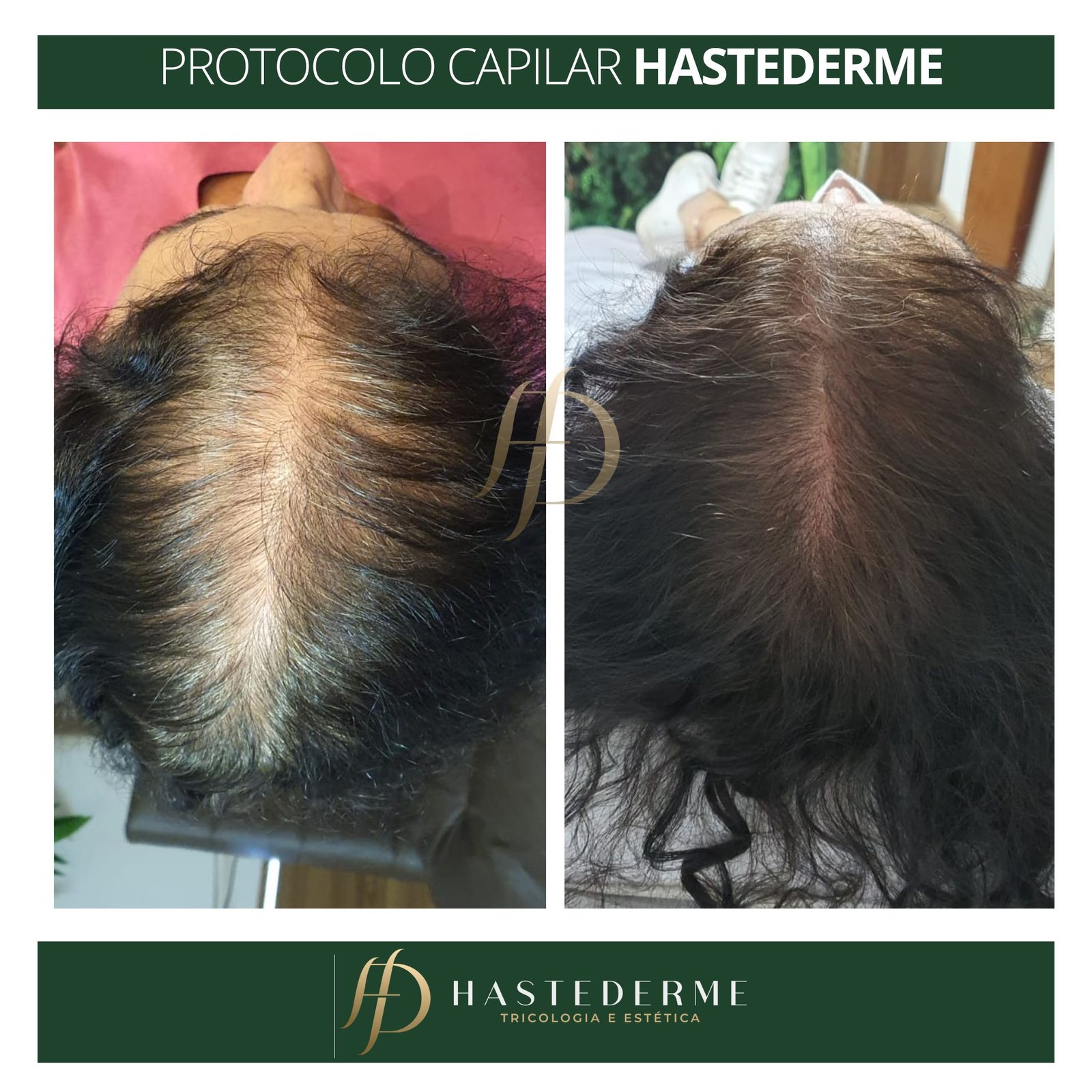 tratamento calvicie feminina