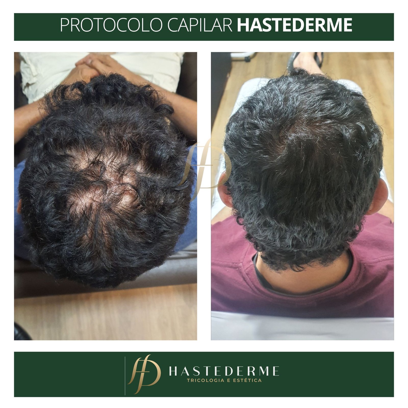 resultado de tratamento capilar na hastederme