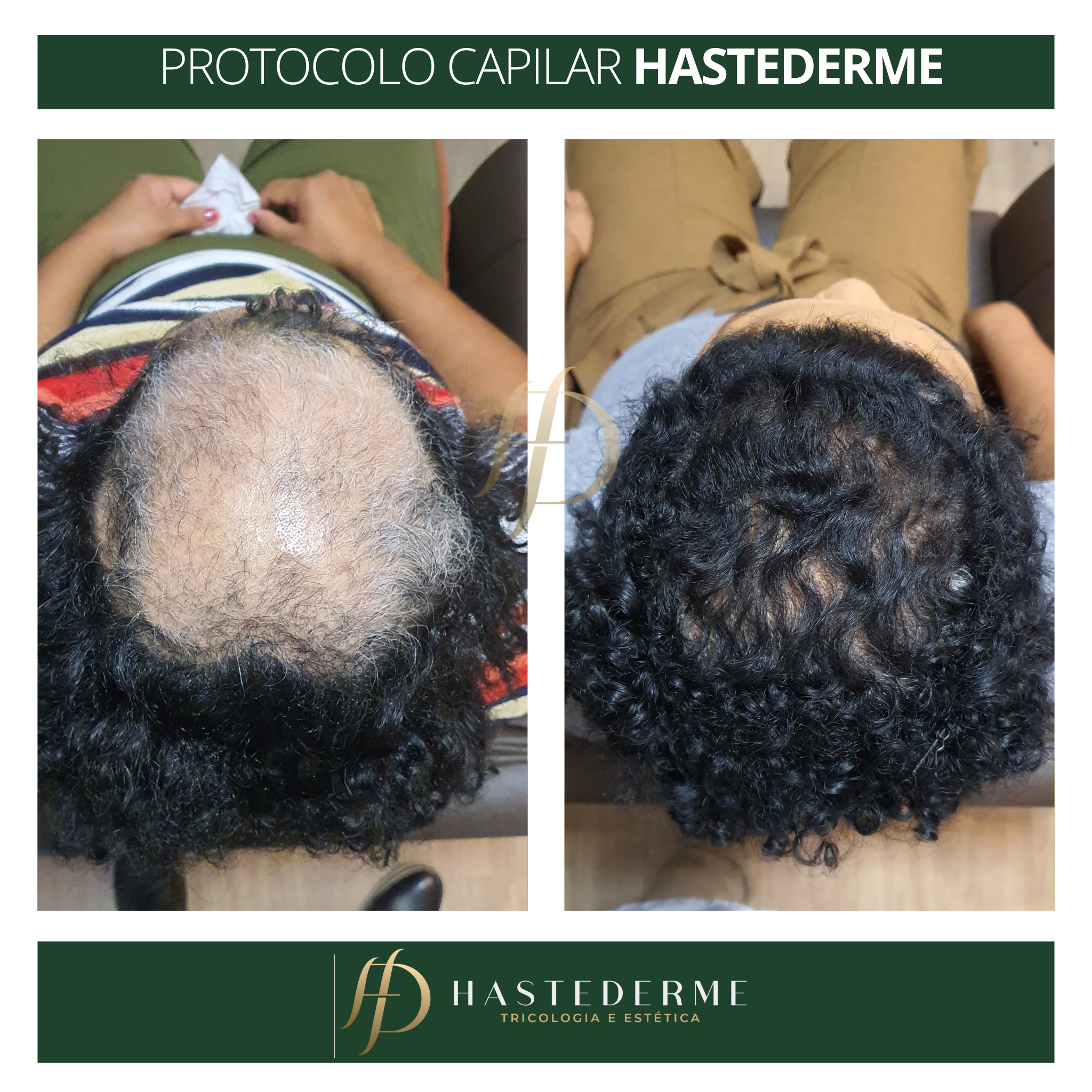 Antes e depois tratamento capilar HASTEDERME (3000 × 3000 px) (1) Antes e depois tratamento capilar HASTEDERME (3000 × 3000 px) (1)