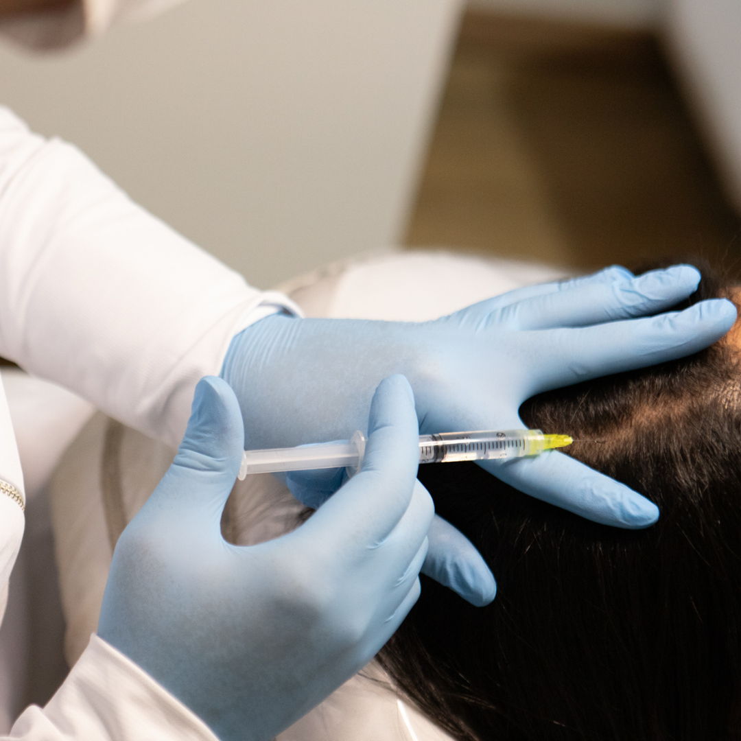 mesoterapia / intradermoterapia capilar intradermoterapia capilar na hastederme - tricologia e estética