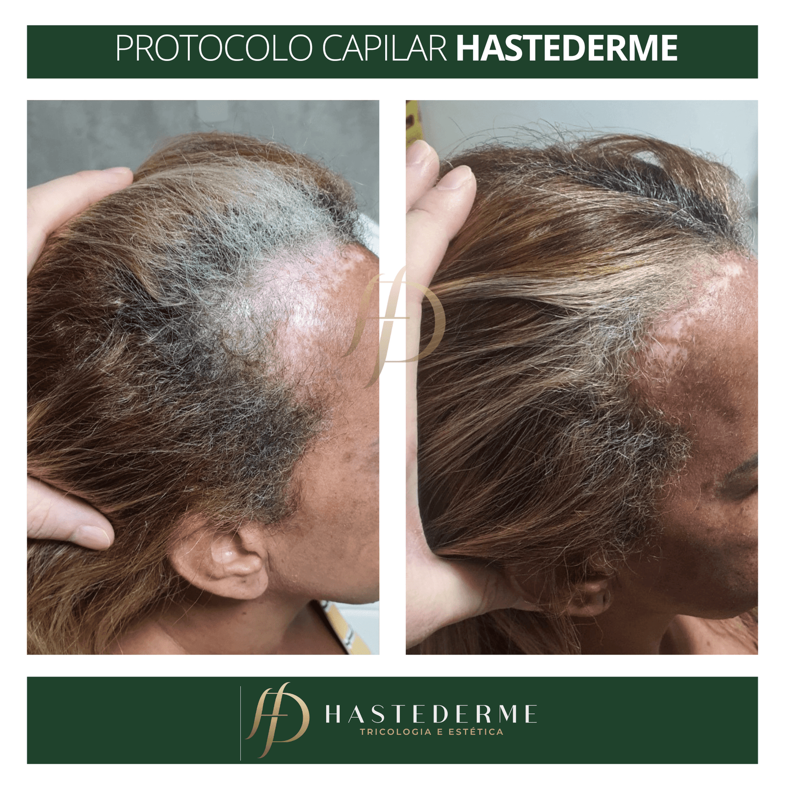 Antes e depois tratamento capilar HASTEDERME (3000 × 3000 px) (22)