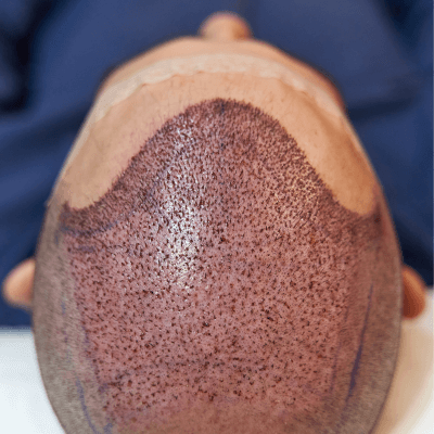 pré e pós transplante capilar