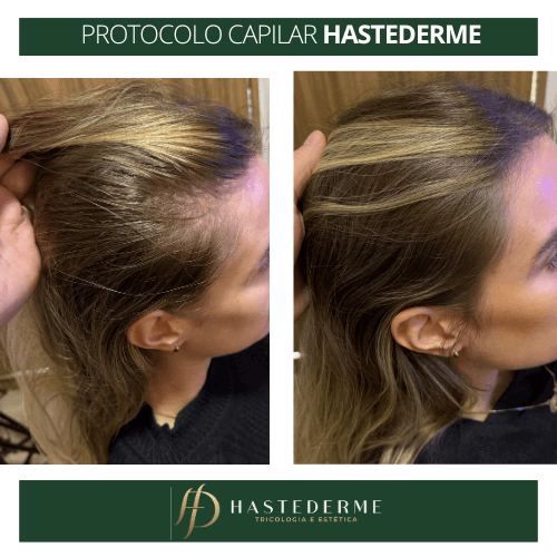 Antes e depois tratamento capilar HASTEDERME (3000 × 3000 px) (500 x 500 px) (19)