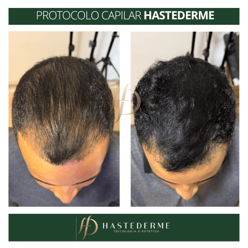 tratamento capilar masculino