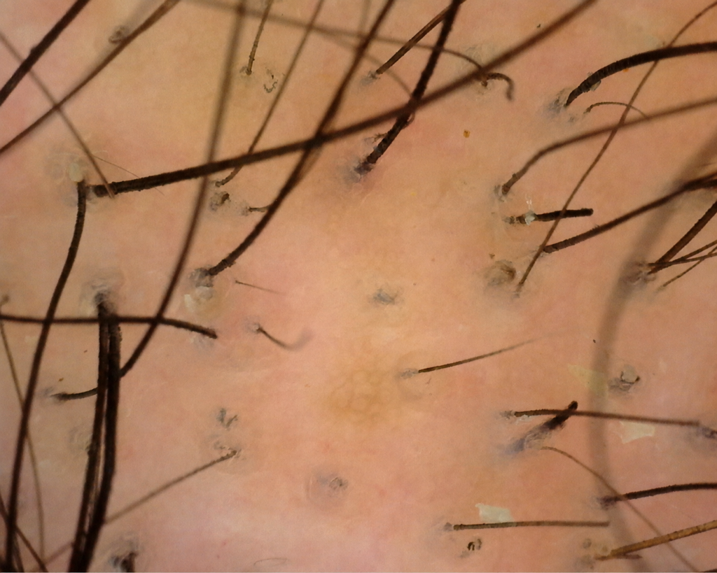 Tricoscopia digital do couro cabeludo realizada na HASTEDERME em Belo Horizonte