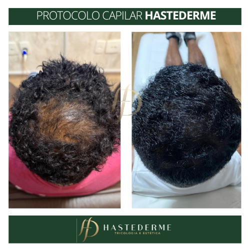 Evolução de tratamento com ozonioterapia capilar na HASTEDERME em Belo Horizonte