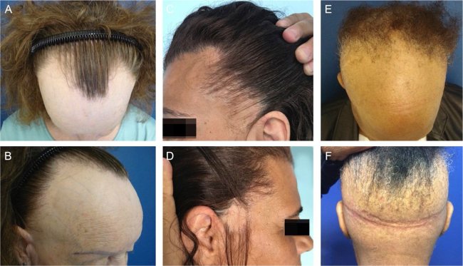 Diferentes padrões clínicos de alopecia fibrosante frontal em homens e mulheres