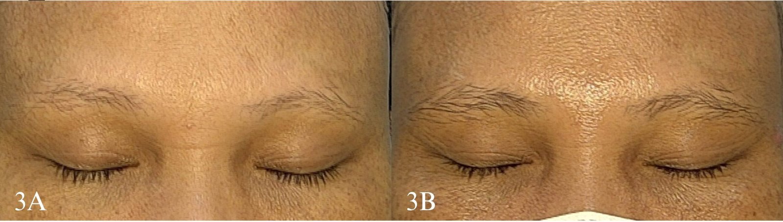 Rarefação das sobrancelhas em paciente com alopecia fibrosante frontal