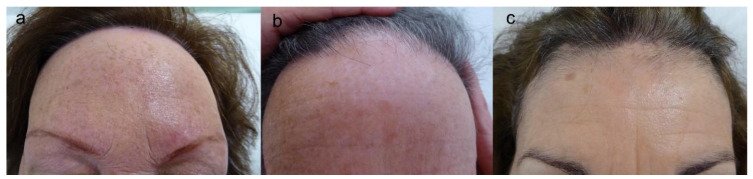 Retração da linha frontal dos cabelos causada por alopecia fibrosante frontal