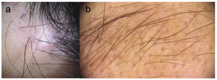 Eritema e hiperqueratose perifolicular na alopecia fibrosante frontal vistos na tricoscopia