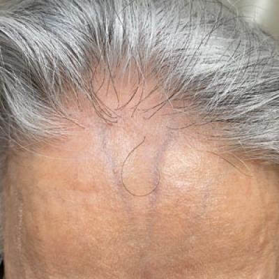 Lonely hair sign com fio isolado na linha frontal na alopecia fibrosante frontal